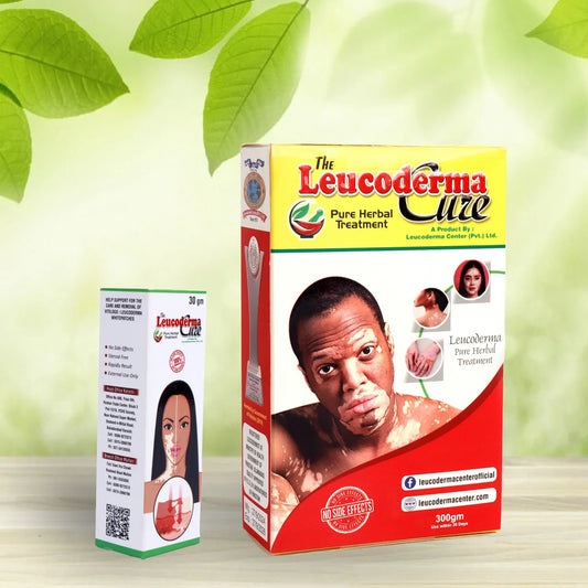 Leucoderma Cure with Cream